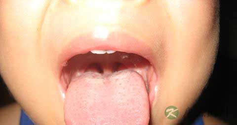 孩子扁桃体反复发炎怎么办