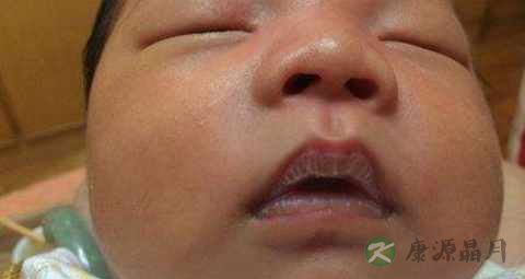 新生儿嘴唇发青是怎么回事