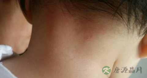 夏天宝宝脖子红是什么原因