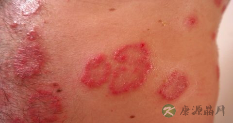 腿上有红点怎么办