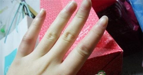 冻疮怎么办