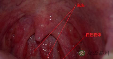慢性咽炎怎么治疗