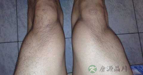 神经性肌肉病有哪些