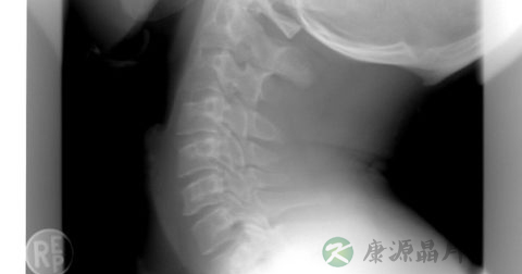 哪些舞蹈动作预防颈椎腰椎病