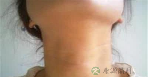 甲亢患者能跳舞吗