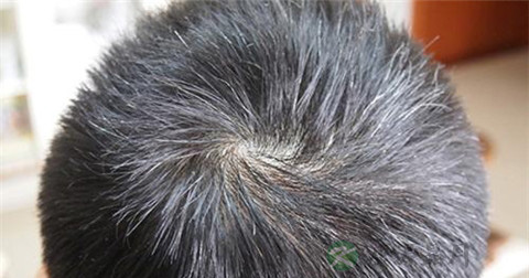 秃发性毛囊炎用什么药