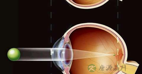 什么是近视眼