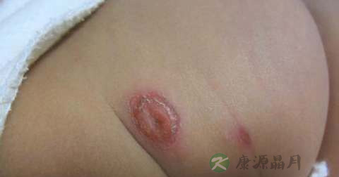 脓包疮是怎么引起的