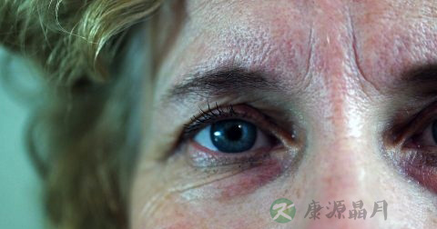 急性结膜炎症状