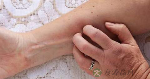 为什么会得皮炎