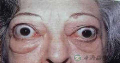 甲亢检查的正常值