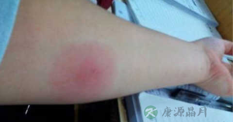 丹毒为什么硬结
