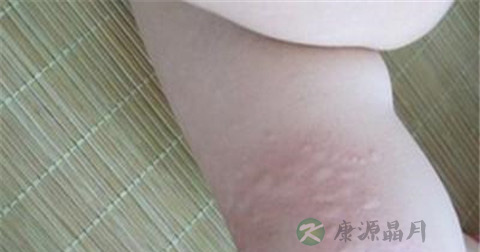 人工性荨麻疹怎么治疗