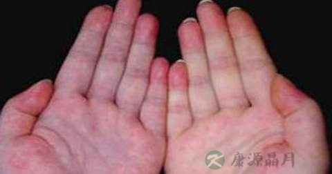 什么是红斑狼疮