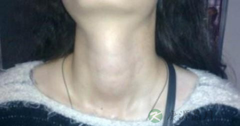 甲状腺癌甲状腺功能正常吗