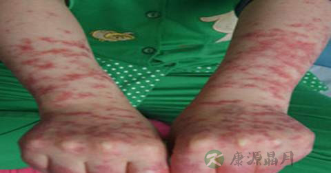 什么是红斑狼疮