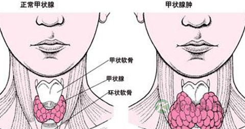 甲状腺异位能治好吗