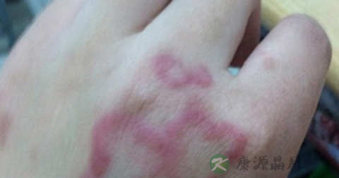 丘疹是如何引起的