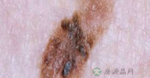 什么是黑色素瘤