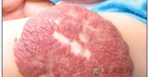 海绵状血管瘤会自己消失吗