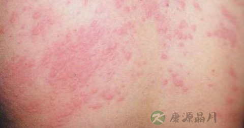 荨麻疹的症状