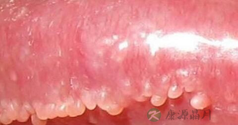 珍珠状丘疹的症状