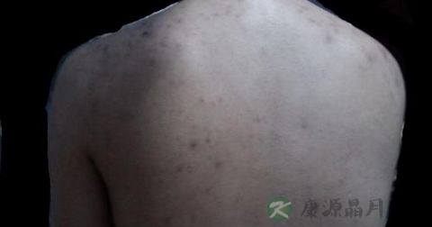 肛门毛囊炎挂什么科
