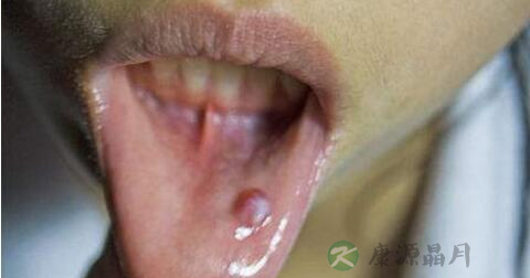 唾液腺囊肿怎么治疗