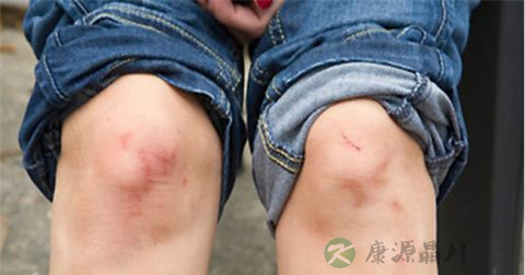 佝偻病后遗症是什么