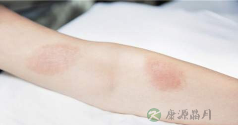 丘疹是什么引起的