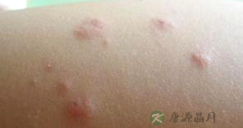 脓包疮是怎么引起的