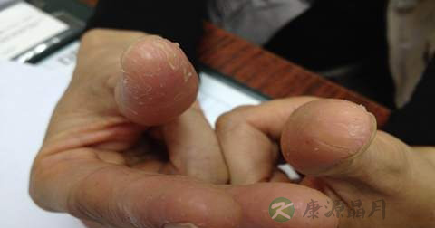 什么是接触性皮炎