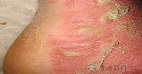 梅毒怎么检查