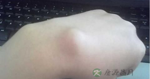 什么是腱鞘炎