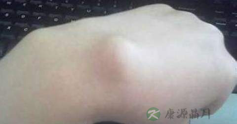 皮炎囊肿是怎么形成的
