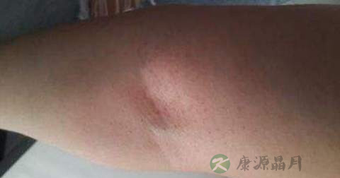 什么是皮疹