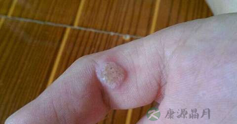 什么是花柳病