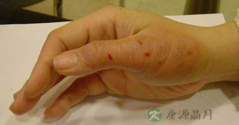 什么是接触性皮炎