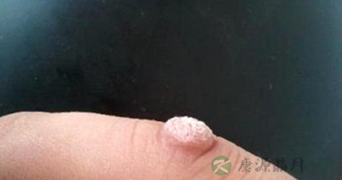 手上为什么会长瘊子