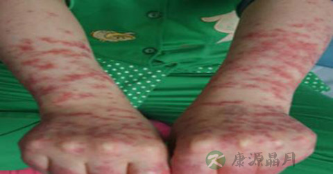 日光性皮炎原因