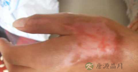 烫伤为什么要用弹力绷带