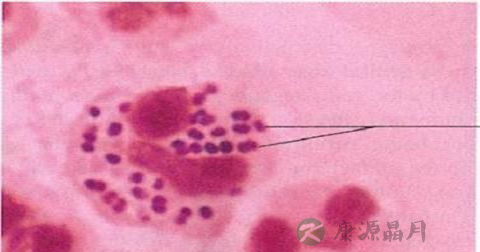 结膜炎症状
