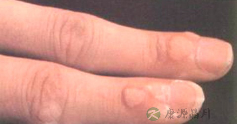 手上为什么会长瘊子