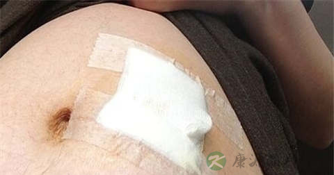 羊水穿刺怎么做