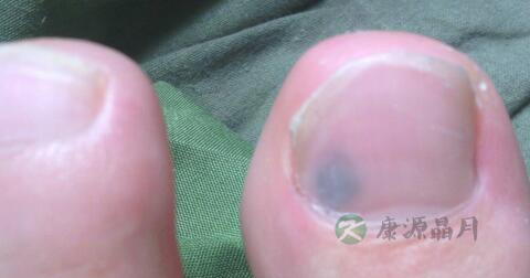 甲藓用什么药好