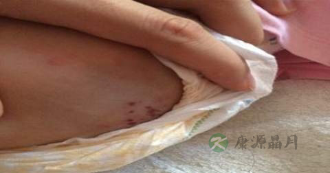 口手足病口腔糜烂服什么药