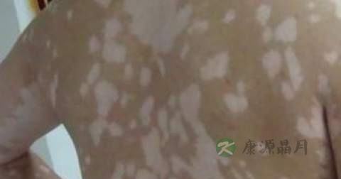 白癜风吃什么药控制不扩散