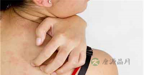 红屑要抹什么药