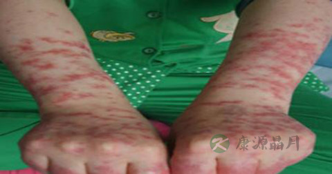 狼疮红斑抹什么药