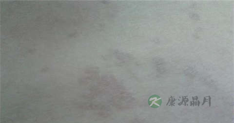 蛛蛛疮拿什么药